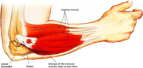 help!is this tennis elbow? | Talk Tennis