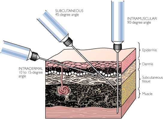 intramuscular injection