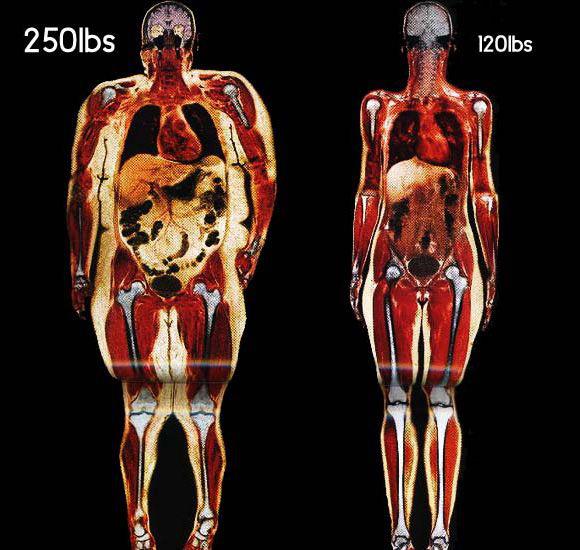 visual representation 30 lbs of fat