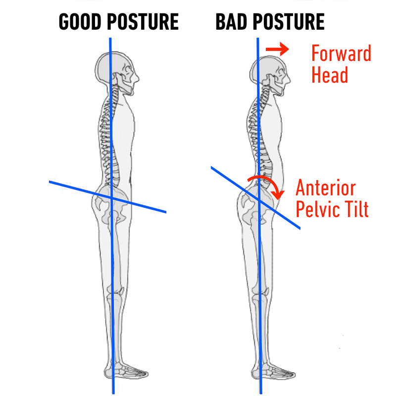 Instagram Butt, Anterior Pelvic Tilt and How to Fix Bad Posture in 4 ...