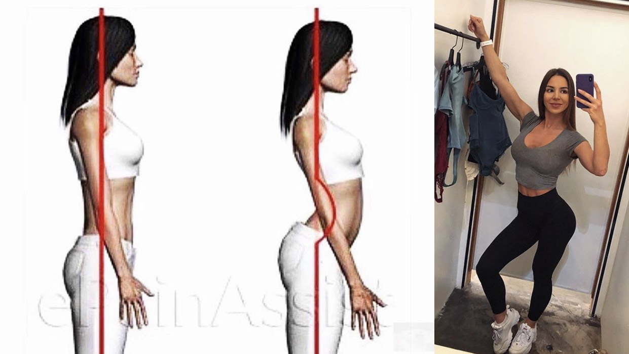 Instagram Butt, Anterior Pelvic Tilt and How to Fix Bad Posture in 4 Steps  